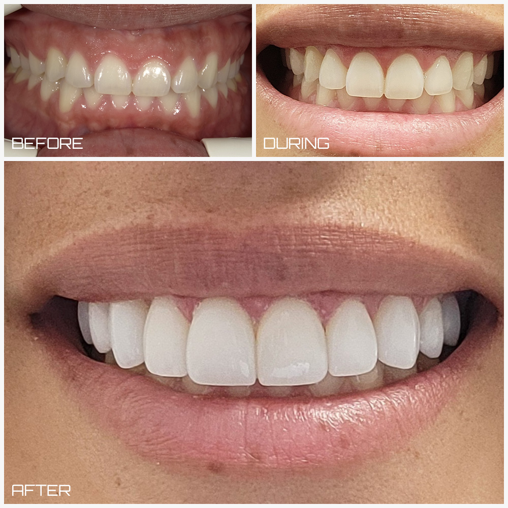 Veneers in Meeker - Grant Family Dentistry